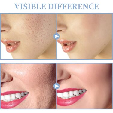 Високочастотний стрижневий апарат для обличчя - високочастотний апарат TUMAKOU - апарат для лікування шкіри з 4 неоновими стрижнями - лікування акне - підтяжка шкіри - зменшення зморшок