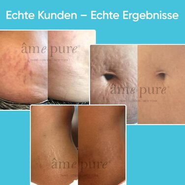 Набір AME PURE Body Roller для видалення розтяжок, 0,75 мм - Ефект від використання CIT Body Roller можна порівняти з ефектом від лазерних процедур на шкірі