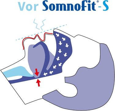 Стоппер від хропіння Somnofit-S - Шина проти хропіння (набір SomniShop з направляючою)