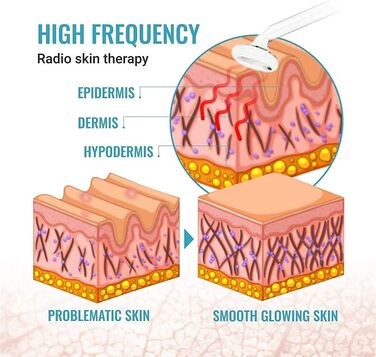 Високочастотні прищі, випадіння волосся, зменшення зморшок, косметичний пристрій для системи догляду за шкірою, красиве обличчя без прищів