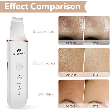 Скраб для шкіри Шпатель для шкіри обличчя Ультразвуковий пілінг Пристрій для очищення шкіри Скраб для видалення чорних крапок Очищувач пір Інструмент для видалення чорних крапок для глибокого очищення