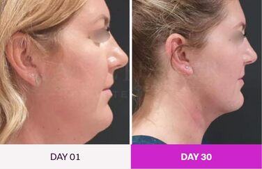 Масажер для обличчя проти зморшок, пристрій для краси обличчя з 7 режимами, пристрій для обличчя для підтяжки шкіри та ліфтингу Ems масаж обличчя (чорний), 7-in-1 Led Facialsculptor Original