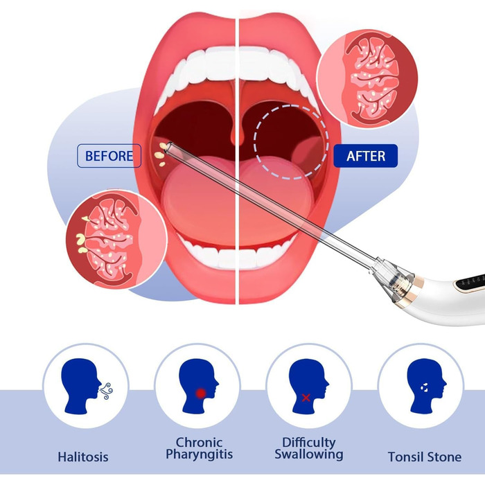 Електричний набір для видалення каменів мигдалин HaliQ - Вакуумна всмоктувальна піпетка - Повний набір для видалення каменів у мигдалинах - Свіжий подих - 5-кратне збільшувальне дзеркало, депресор язика та шприц