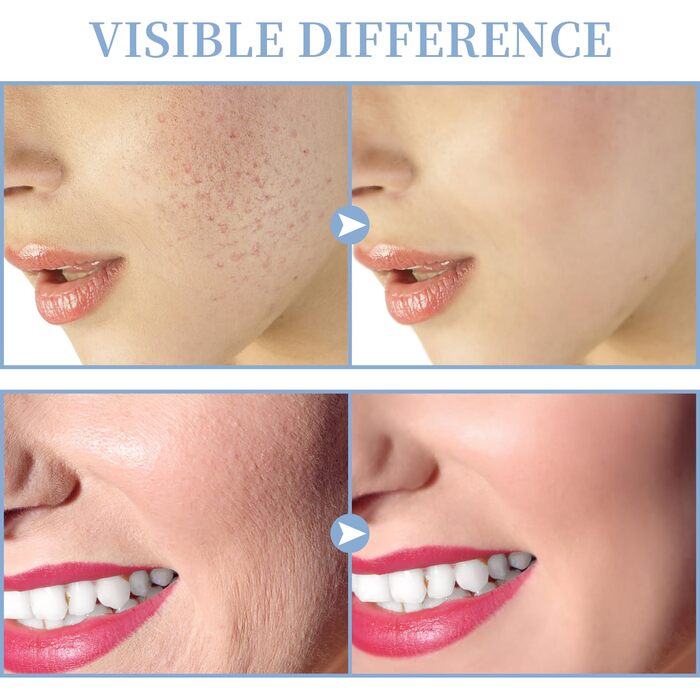 Високочастотний стрижневий апарат для обличчя - високочастотний апарат TUMAKOU - апарат для лікування шкіри з 4 неоновими стрижнями - лікування акне - підтяжка шкіри - зменшення зморшок