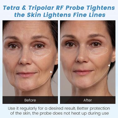 Масажер від целюліту Cozion 40K для схуднення 4 в 1 радіочастотна машина краси для обличчя та тіла, що зміцнює та моделює підтяжку шкіри