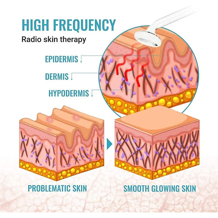 Високочастотні прищі, випадіння волосся, зменшення зморшок, косметичний пристрій для системи догляду за шкірою, красиве обличчя без прищів